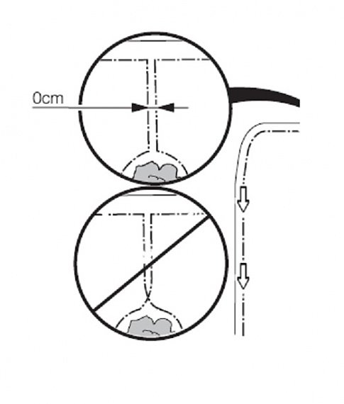 Schematisk illustration av rätt och fel sätt att dra en kabel runt en ö för en robotgräsklippare.