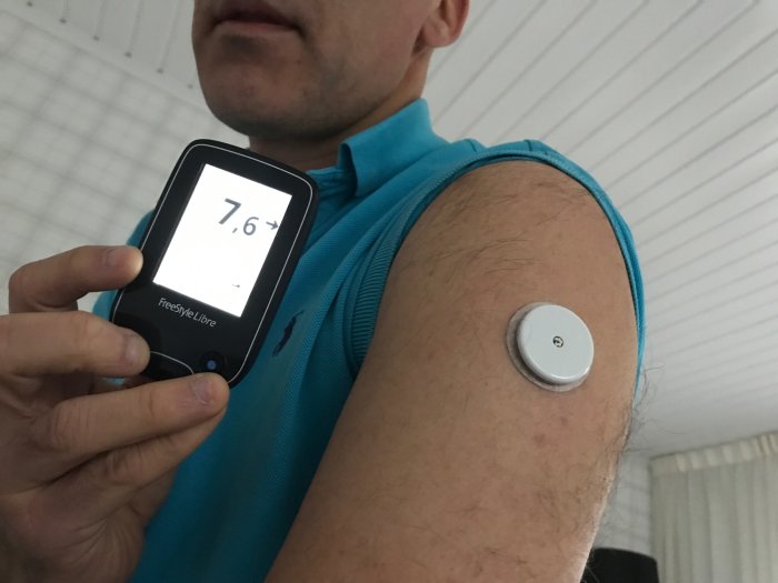 Person med typ 1-diabetes visar sin glukosmonitor och sensor applicerad på överarmen.