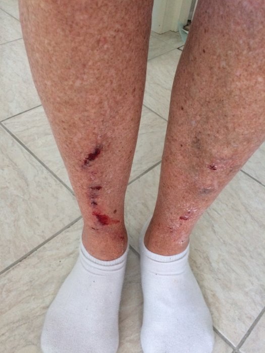 Ben med skrapsår och vit socka, resultat av olycka utan skyddsutrustning vid byggarbete.