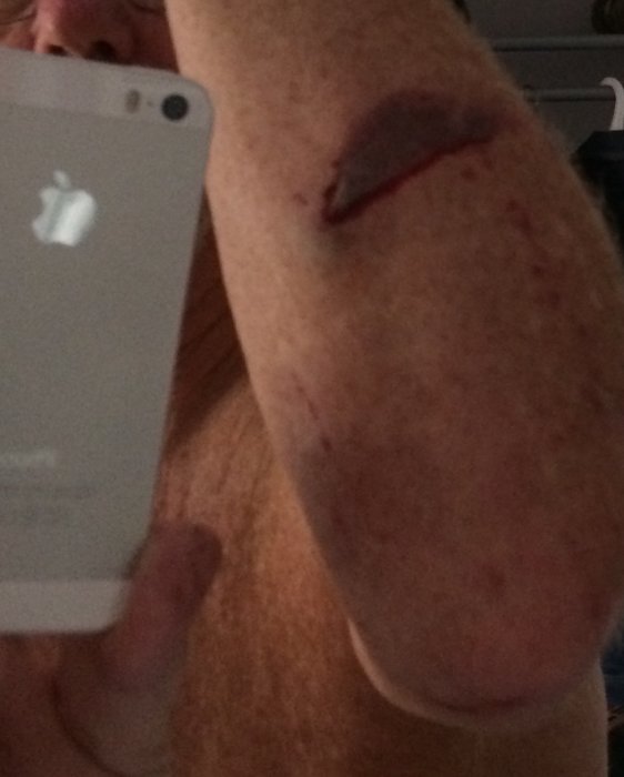 En persons arm med skrapsår speglad i baksidan av en smartphone som hålls i en hand.