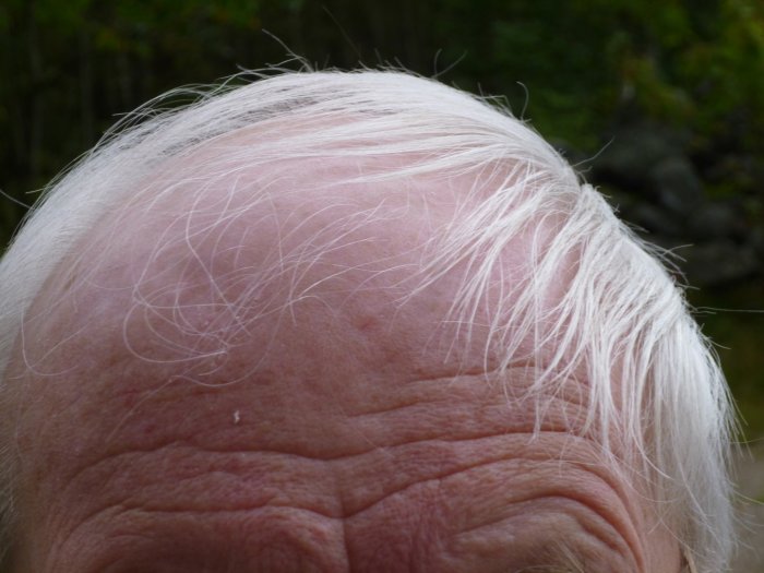 Närbild på en person med sparsamt vitt hår och bar hud på huvudet.