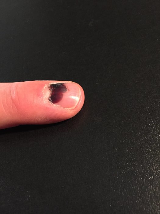 Närbild på en finger med ett blåsvart blånagel som ser ut att ha orsakat smärta.
