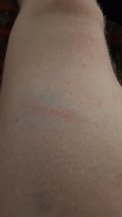 Lår med röd skärsårslinje efter olycka med vinkelslip, närbild som visar skadan på huden.