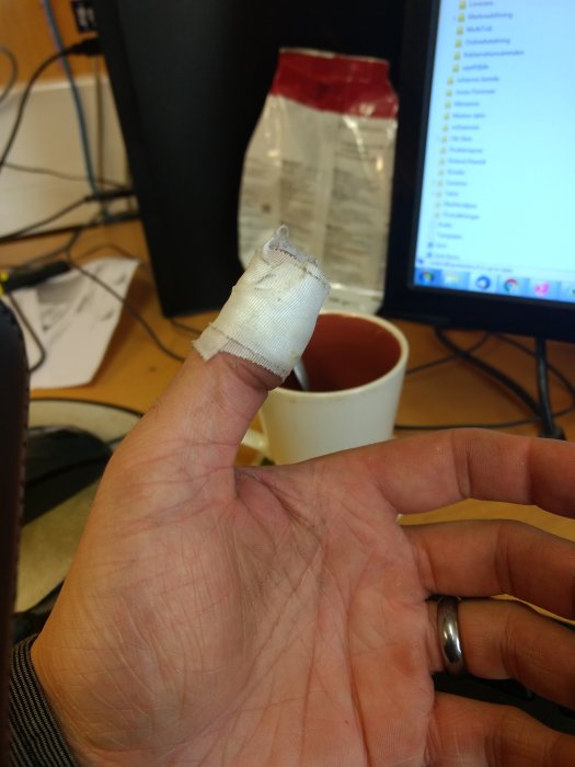 Vänster tumme med bandage och synligt blod, indikation på skada efter slipning av yxa.