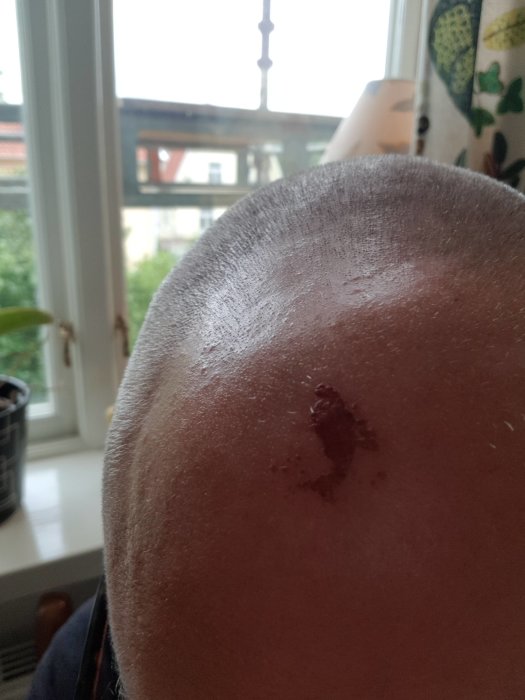 Person som visar ett sår på huvudet, resultat av arbetsrelaterad skada utan skydd.