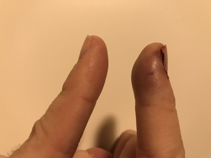 En hand visar ett skadat lillfinger bredvid ett oskadat finger, med en blodig och svullen tipp.