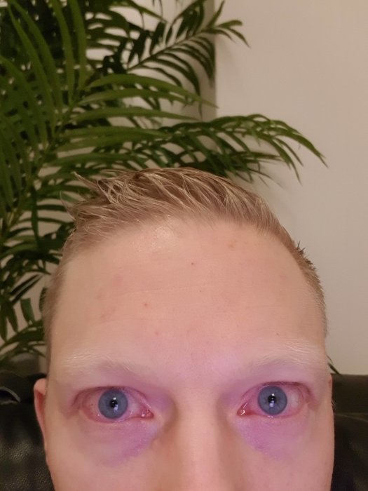 Närbild av en persons ögon och panna efter en excimer laser hornhinnebehandling.