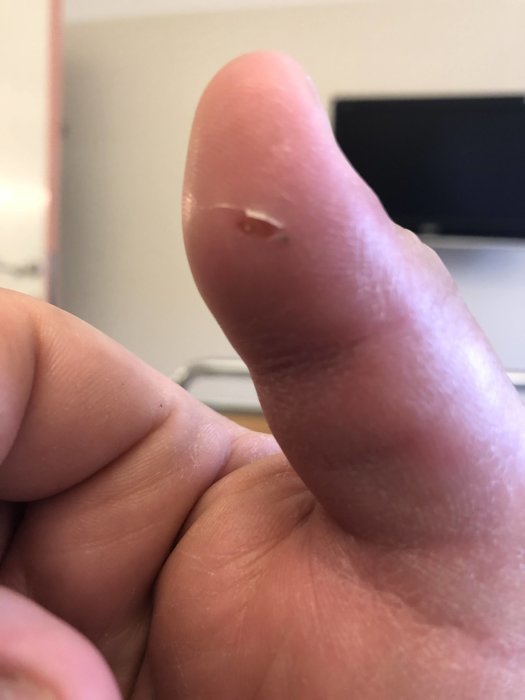Närbild av ett litet sår på en fingertopp, med inflammationssymptom.