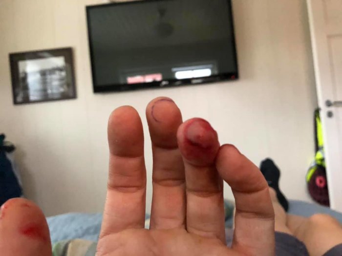 Handskada med blod på fingrarna, bakom syns ett suddigt rum med en TV.