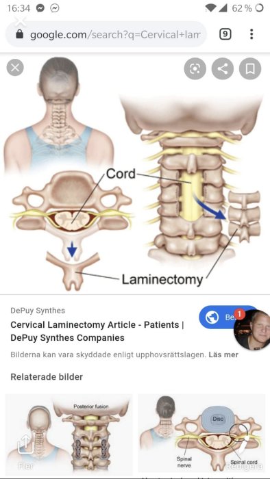 Illustration av en cervical laminectomi, där baksidan av nackkotorna är borttagna för att visa ryggmärgen.