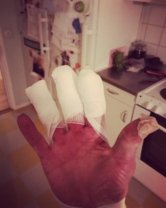 En hand med förband på tre fingrar efter en olycka med ett frässtål, illustrerar riskerna med snickeriarbete.