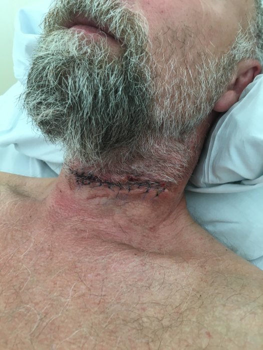 Man med skägg som visar läkt sår med stygn på halsen efter motorsågsolycka.