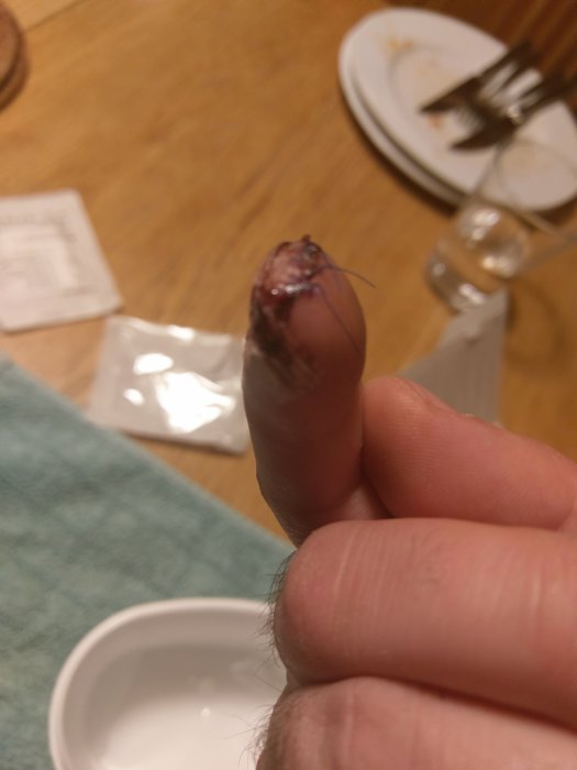 Närbild av en skadad pekfingertopp med stygn, tecken på en äldre sågskada.