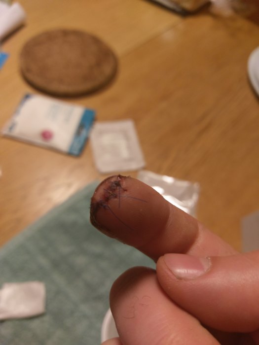 Närbild på en hand som visar ett pekfinger med ett läkt sår och synliga stygn.