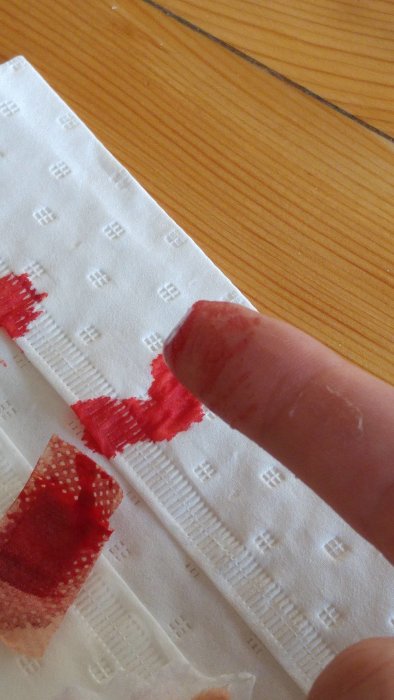 En finger med en skada på fingertoppen, blod på ett servett och en bit avskalad hud.