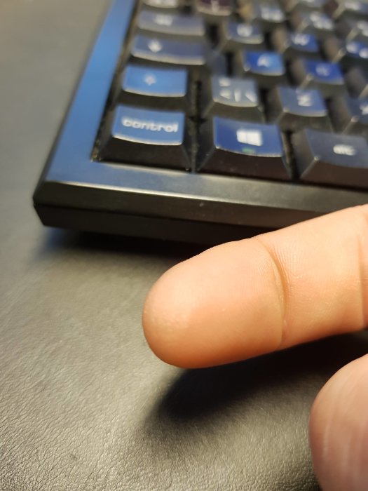 Fingertopp nära tangentbord som visar läkt skada med återställd känsel.