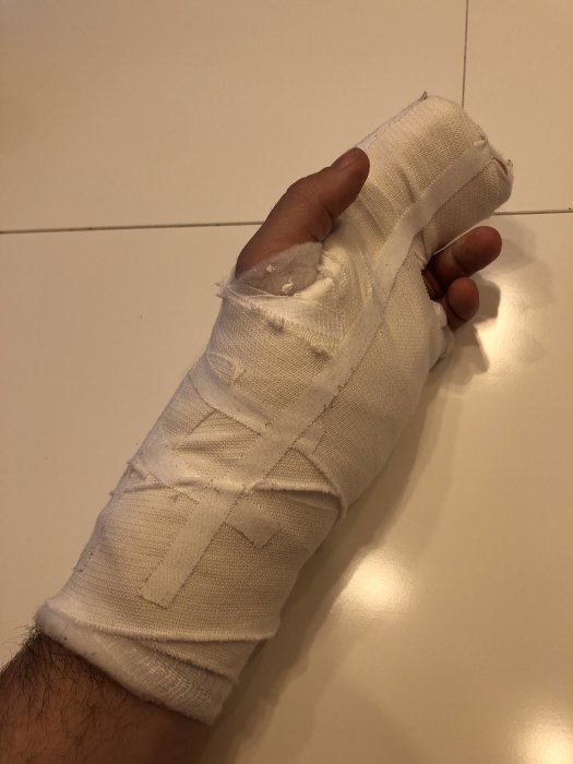 Person som håller upp en hand insvept i gips och fingerskena efter en olycka.