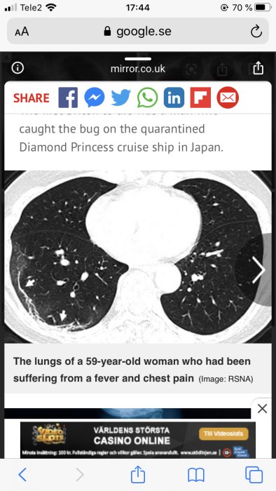 CT-bild av lungor med vita områden som indikerar infektion, troligen orsakade av Coronavirus.