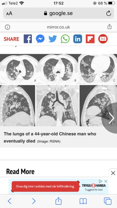 CT-bilder visar lungorna hos en patient med Coronavirus, vita områden indikerar infektion.
