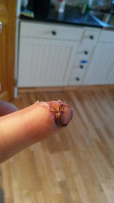 Skadat pekfinger med sår och stygn, efter en olycka med en såg under bygge.