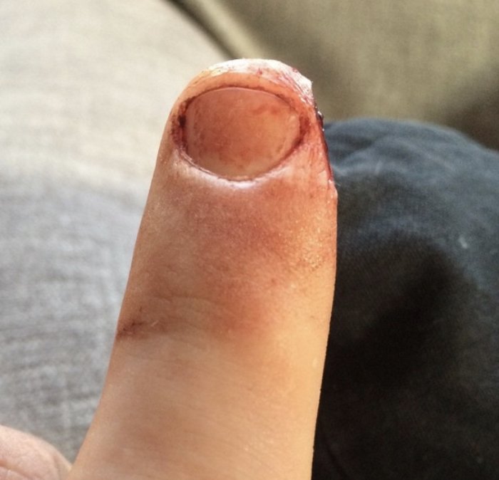 Närbild på en fingertopp med ett snyggt snittskada efter att ha glidit över en linjal vid skärning.
