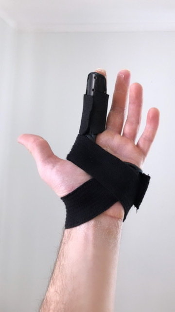 Hand med stödskena på pekfingret efter operation till följd av en sticksågsskada.