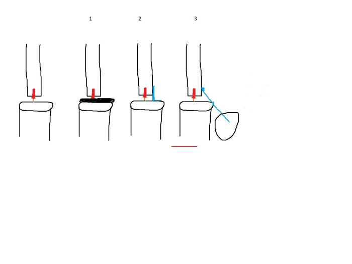 Handritad skiss som illustrerar tre alternativ för att stabilisera staket med stolpskor; gjutning, vinkeljärn och plintjärn.