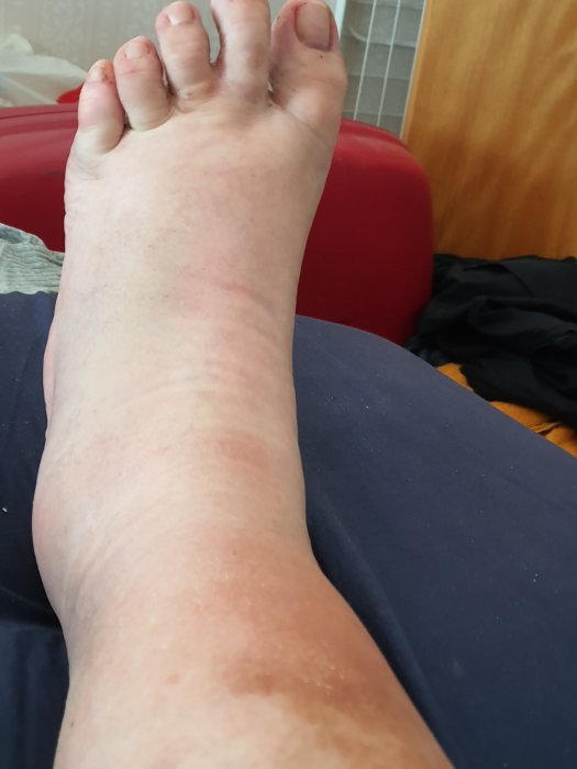En svullen fot och ankel som uppvisar rodnad efter en stukning.