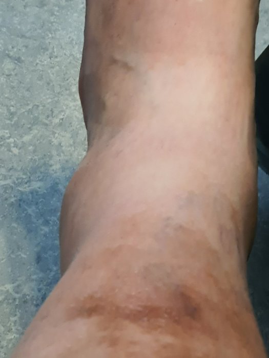 Svullen fotled med tydlig missfärgning efter stukning.