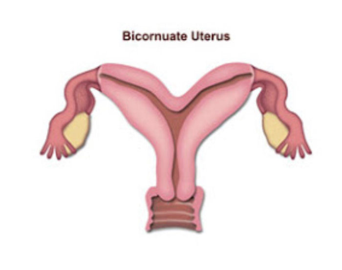 Illustration av en missbildad livmoder, känt som uterus bicornis.