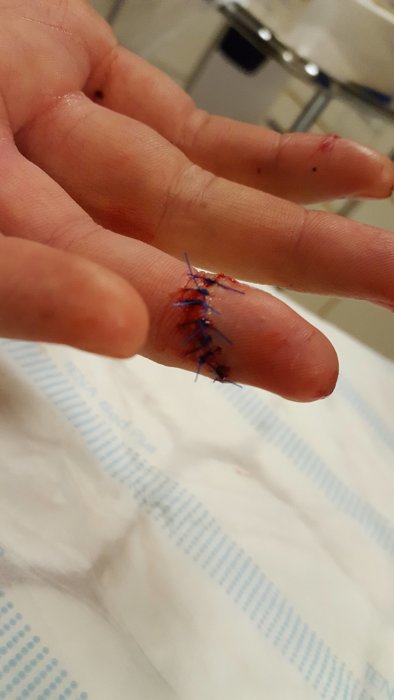 Närbild på en persons hand med ett skadat ringfinger som har 8 stygn, efter en olycka vid takarbeten.