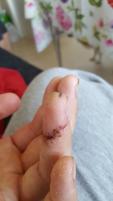 Närbild på ett ringfinger med ett läkande sår och stygn efter en skärskada.