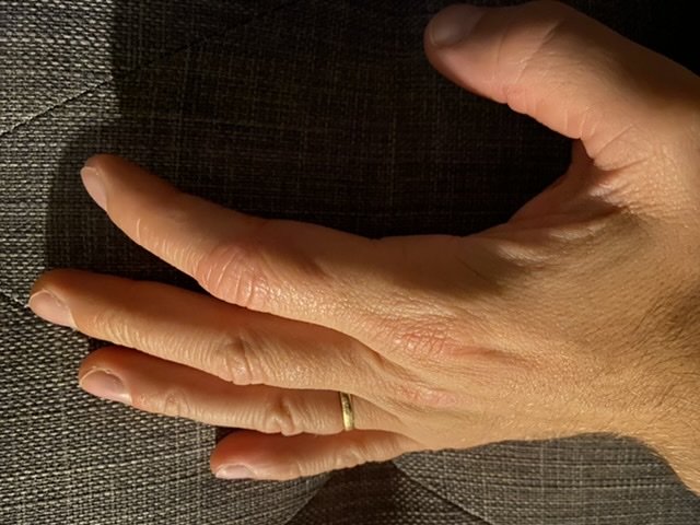 Hand med begränsad rörlighet som försöker böja fingrarna, synligt deformerat finger.