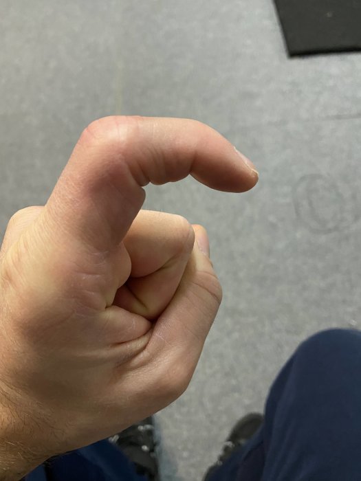 Någons hand med ett skadat och delvis böjt pekfinger efter en sågolycka.