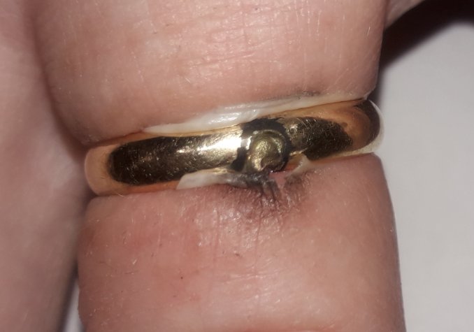 Bränd och smält område på en guldring som bärs på ett finger med tecken på en brännskada under ringen.