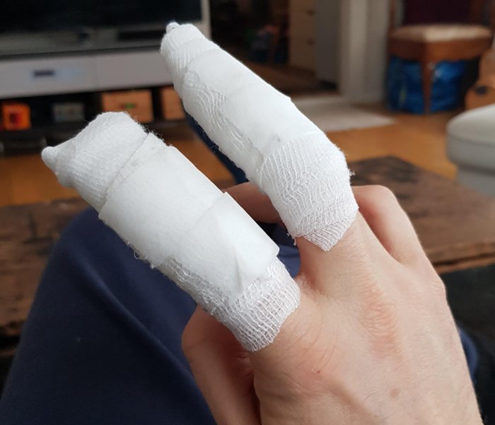 En hand med bandage på två fingrar efter ett snickeriarbetsolycka.