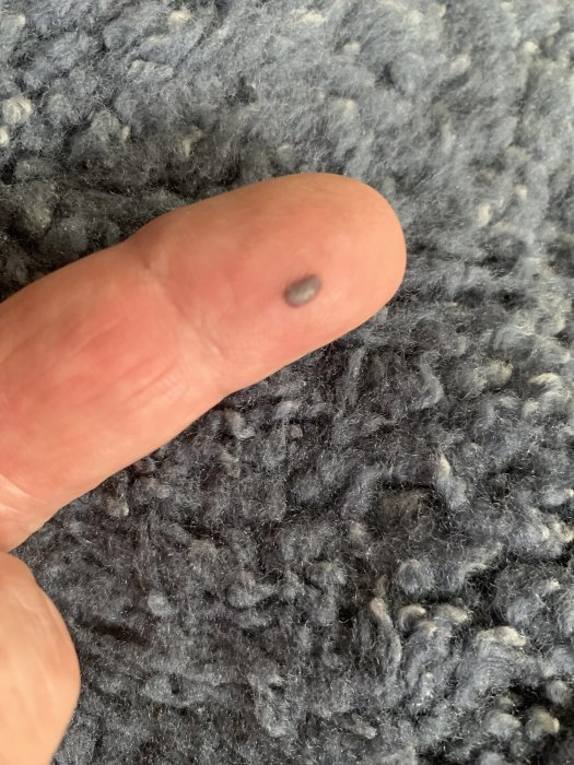 Finger med blåmärke efter att ha klämts av kraftiga små magneter.