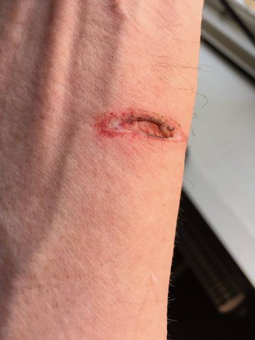 Närbild på en persons handled med en brännskada efter en olycka med en metallkapskiva.