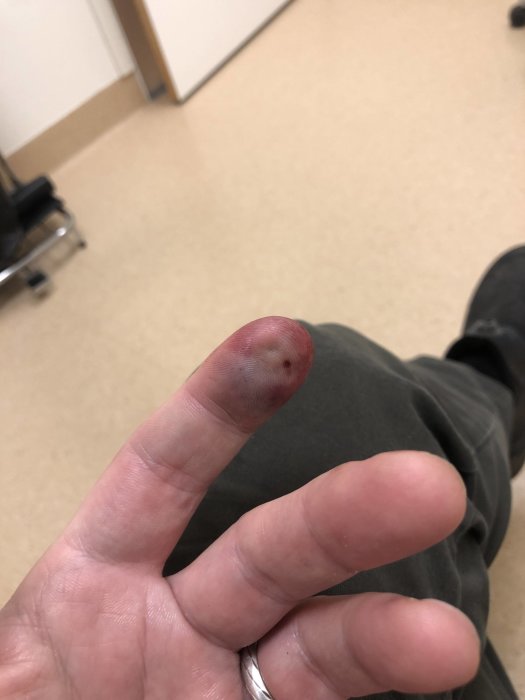 Person som visar upp ett skadat finger med en blånad efter att ha slagit det i en bildörr.