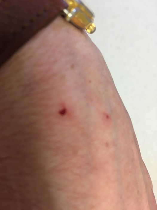 Närbild av en arm med små röda kattklorssår och en guldring.