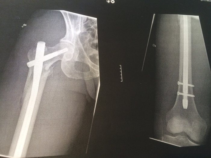 Röntgenbilder som visar frakturer på en höft och ett underben med metallimplantat efter operation.