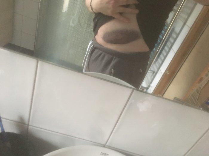 Person visar ett stort blåmärke på ryggen framför en spegel i ett badrum.