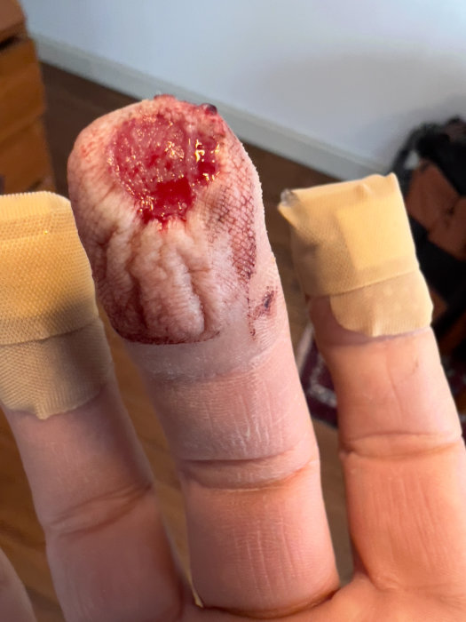 Ett skadat finger med bandage och synlig såryta.