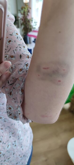 Arm med blåmärken och skrubbsår, klädd i blommigt rosa tyg. Bakgrund suddig, inomhusmiljö.