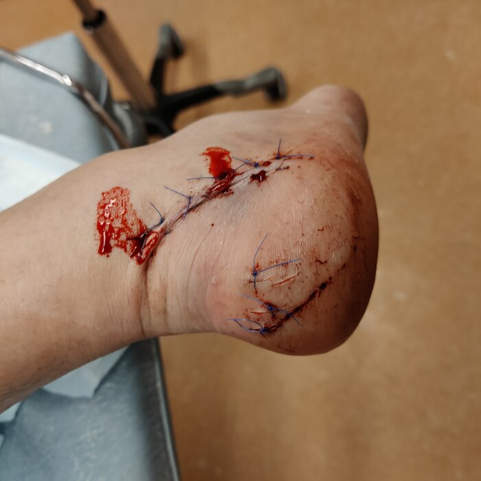 En hand med synliga stygn och sår efter medicinsk behandling.