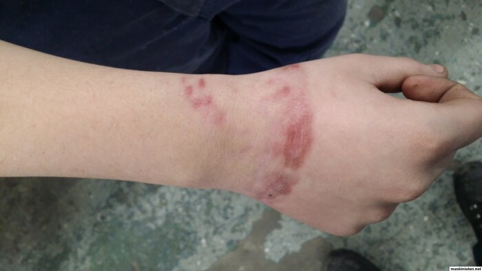 Personens arm med blåmärken efter olycka vid arbete med blocknyckel.