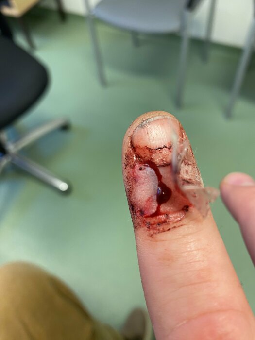 Skadat finger med sår nära nageln, omtejpat och rengjort efter läkarbesök.