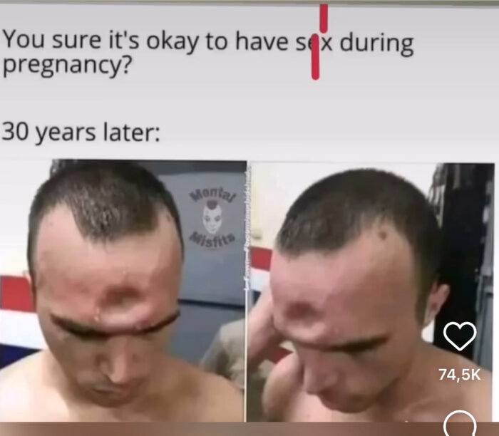 Meme med texten "You sure it's okay to have sex during pregnancy?" och "30 years later:" med en bild på en man med ett stort intryck på pannan.