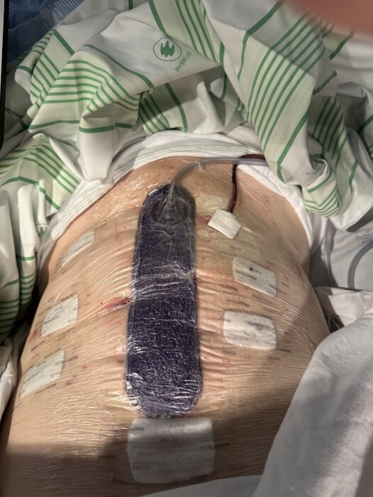 Bilden visar en mage med bandage och medicinsk utrustning efter operation, inlindad i plast med synliga sårtejpade områden.