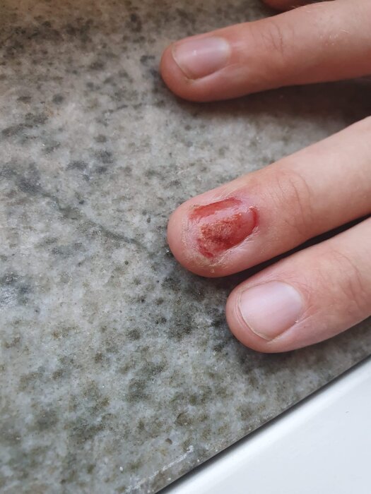 Finger med skada där nageln är borttagen, nära bild på handen, hudens textur och sårbarheten synliga.
